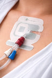 MEDICAZIONE PER FISSAGGIO CATETERI CON CLOREXIDINA (25 pezzi)